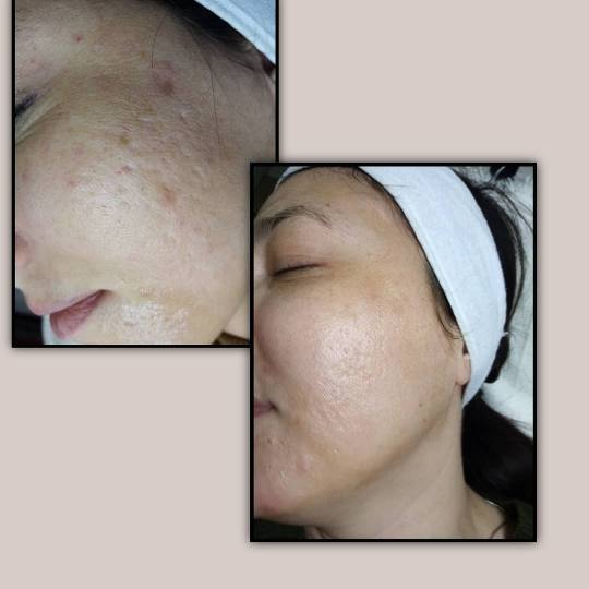 NutriMedicalCentar #beograd Dermaroler i dermapen Dermapen lica - uklanjanje ožiljaka Tretman lica 