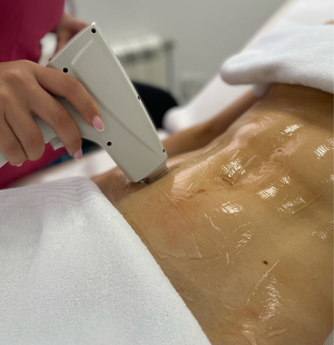 GM Beauty studio #beograd Laserska epilacija Laserska epilacija celog stomaka - za dame