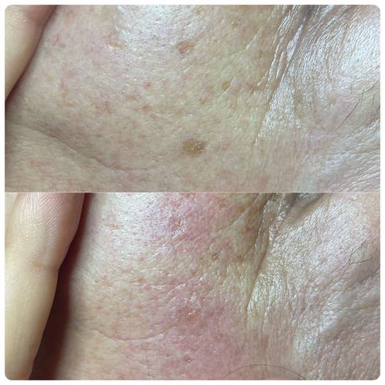 Lancier Beauty Expert #beograd Tretman lica Plazma lift lica - jedna regija Uklanjanje fleka pre i o