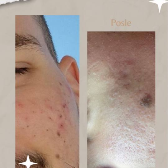 Lancier Beauty Expert #beograd Tretman lica Higijenski tretman lica