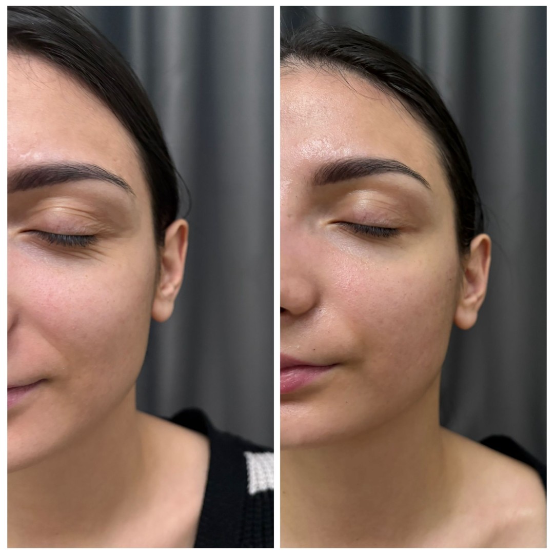 Leonis Beauty Premium #beograd Tretmani vrata i dekoltea Fitt limfno modelovanje lica ,vrata i dekoltea