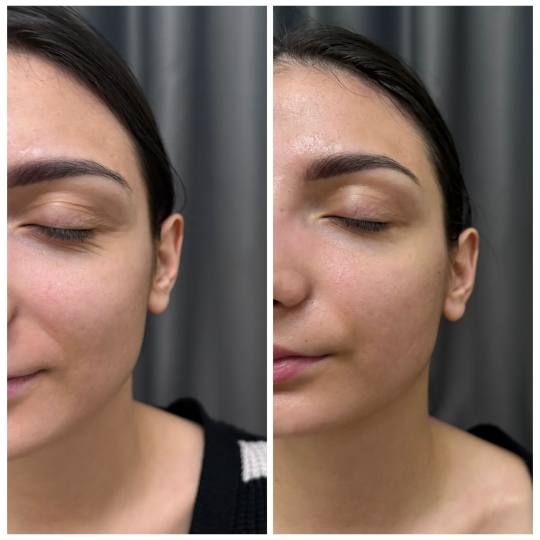 Leonis Beauty Premium #beograd Tretmani vrata i dekoltea Fitt limfno modelovanje lica ,vrata i dekol