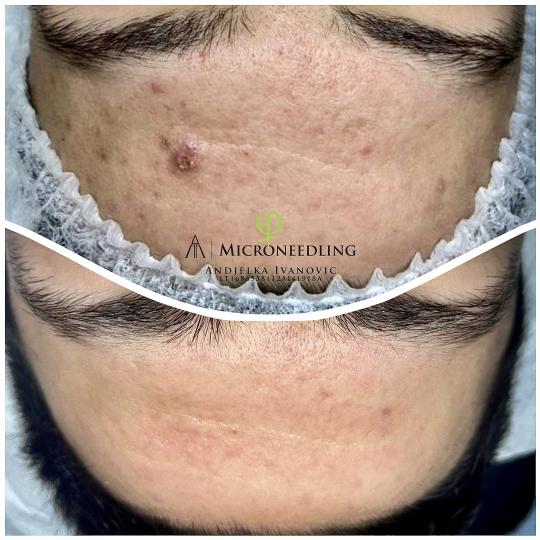 Belle Ana #beograd Tretman lica Microneedling tretman - lice