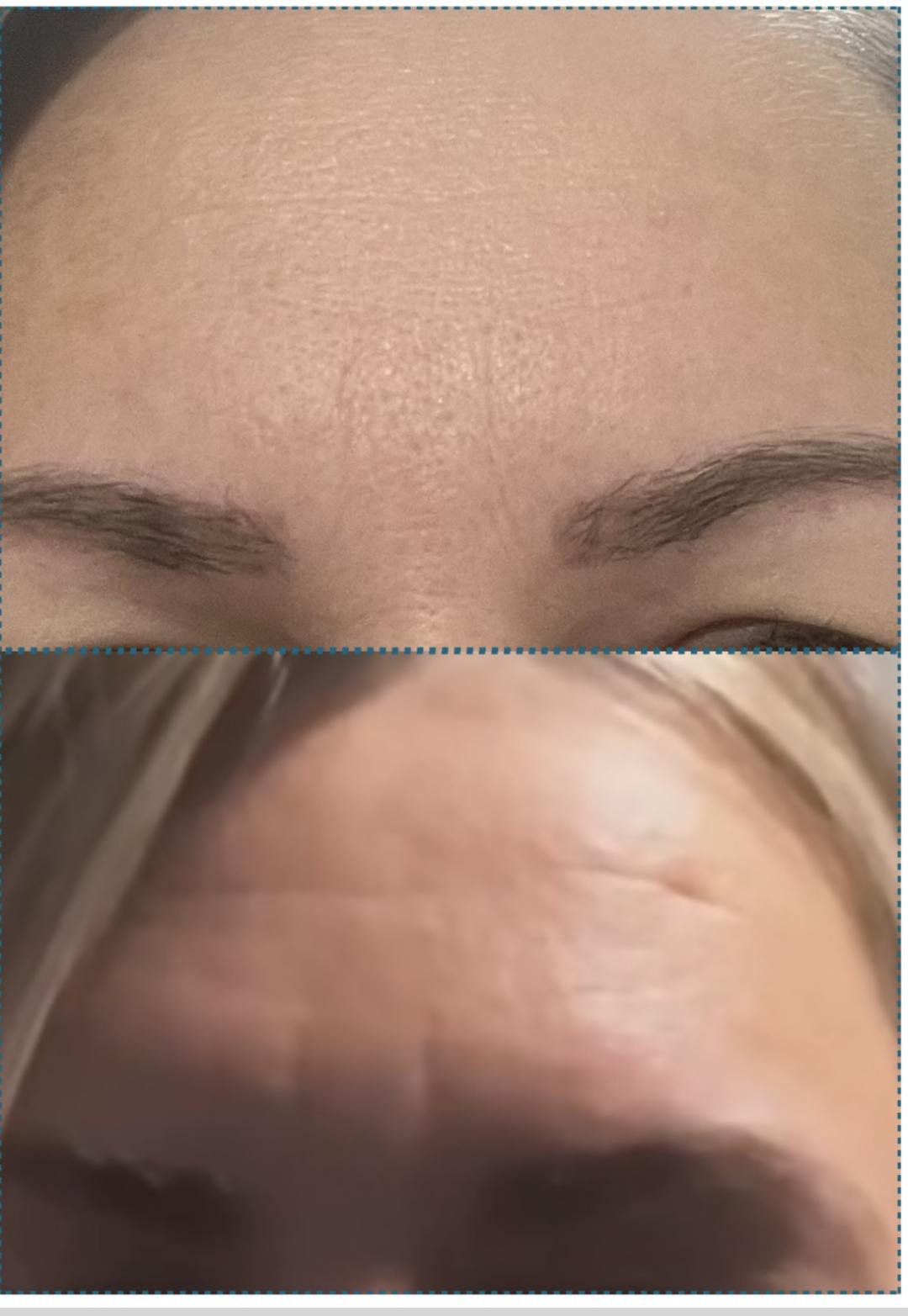 Amelini beauty concept #beograd Tretman lica Radiotalasni lifting lica