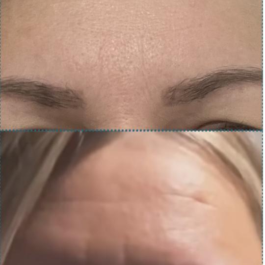 Amelini beauty concept #beograd Tretman lica Radiotalasni lifting lica