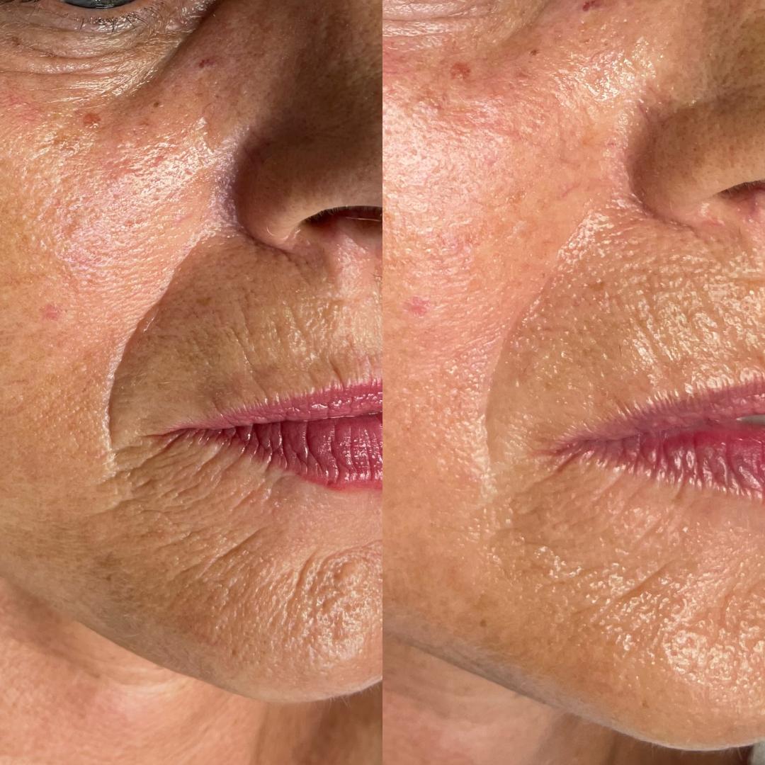 Mask #beograd Dermaroler i dermapen Dermapen tretman lica + hemijski piling