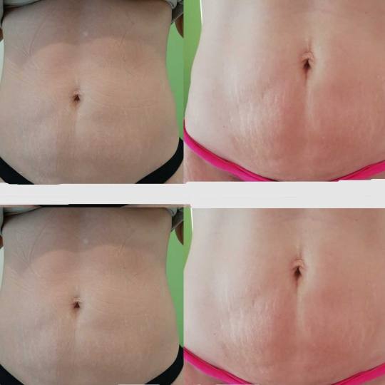 Olja Beauty #beograd Lifting / zatezanje kože HiFu tretman lica - po regiji 3D HIFU