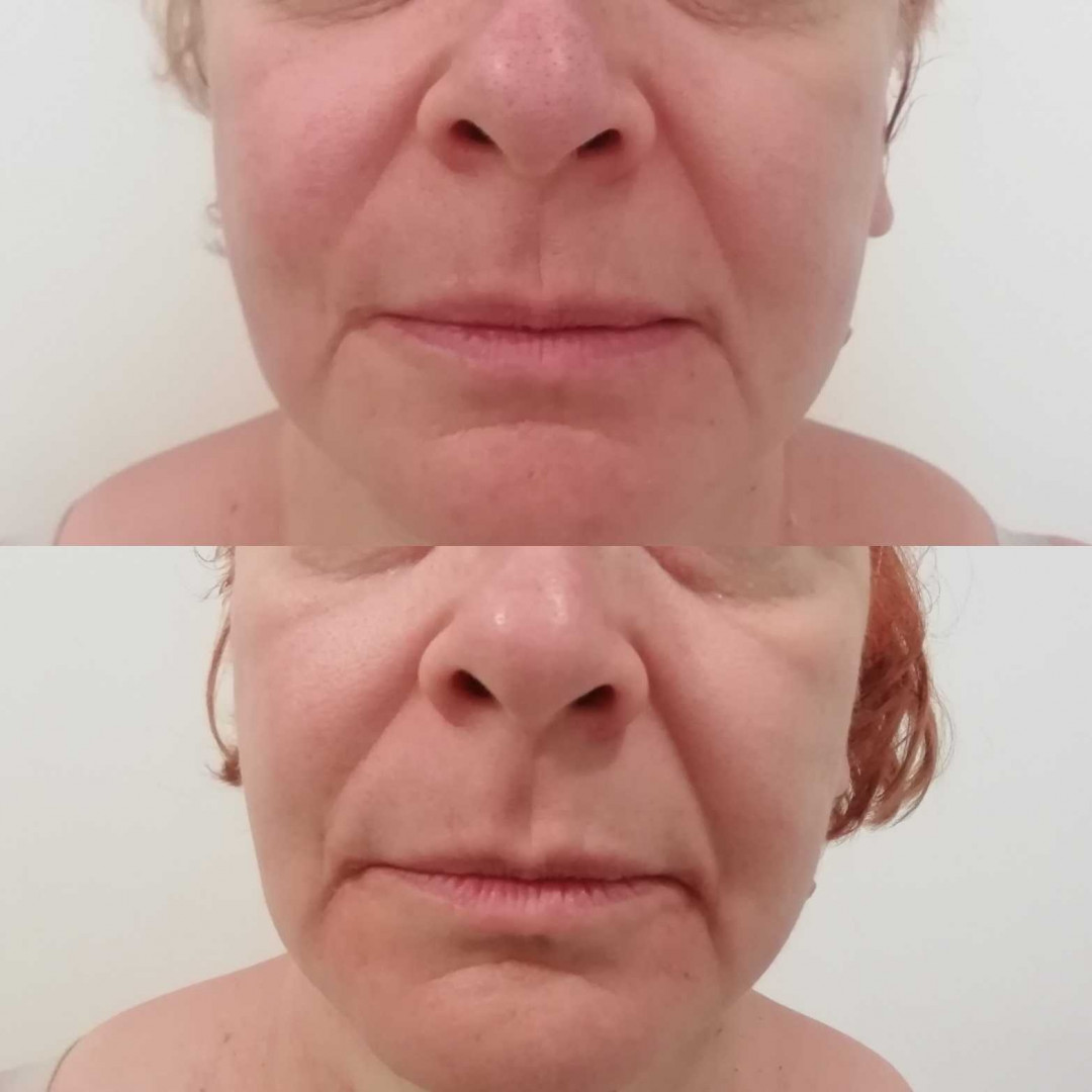 Olja Beauty #beograd Lifting / zatezanje kože HiFu tretman lica - po regiji