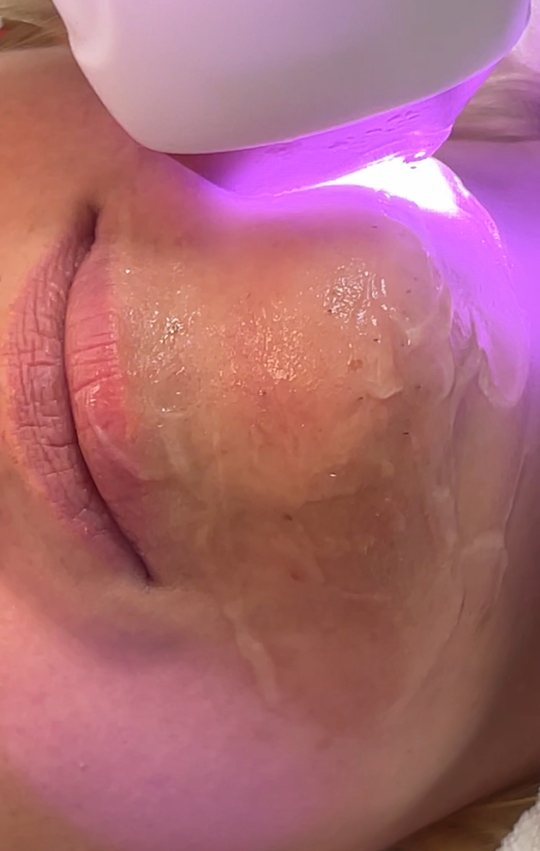 Odraz lepote #beograd Laserska epilacija Laserska epilacija malih regija (nausnice, podbradak, brada ili zulufi) - za dame