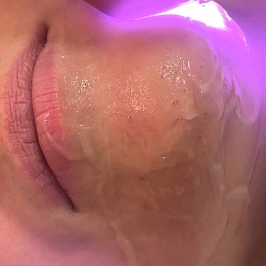 Odraz lepote #beograd Laserska epilacija Laserska epilacija malih regija (nausnice, podbradak, brada