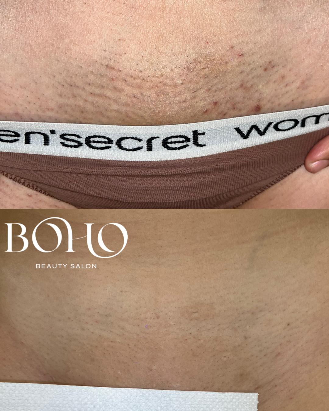 Boho Beauty #beograd Laserska epilacija Laserska epilacija brazilke - za dame