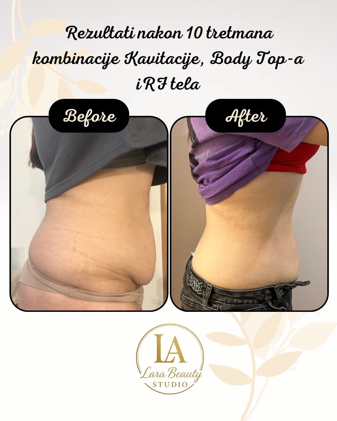 Body top - paket od 10 tretmana - Lara Beauty 037, Kruševac Tretmani tela Telo Tretmani tela, Kruševac, Centar