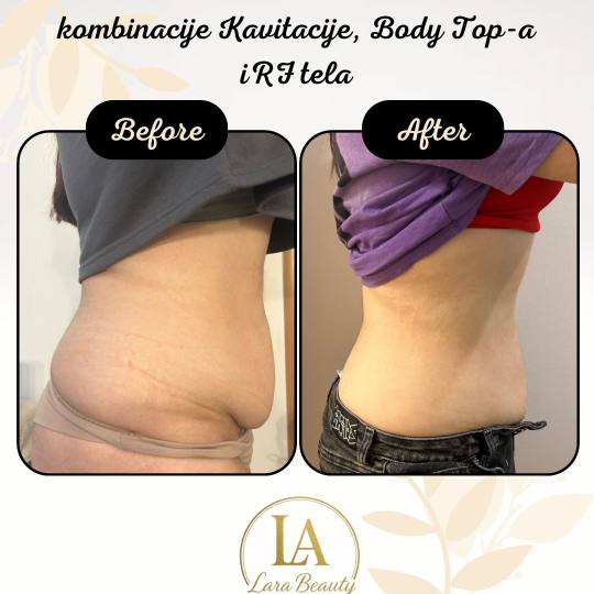Lara Beauty 037 #krusevac Tretmani tela Body top - paket od 10 tretmana