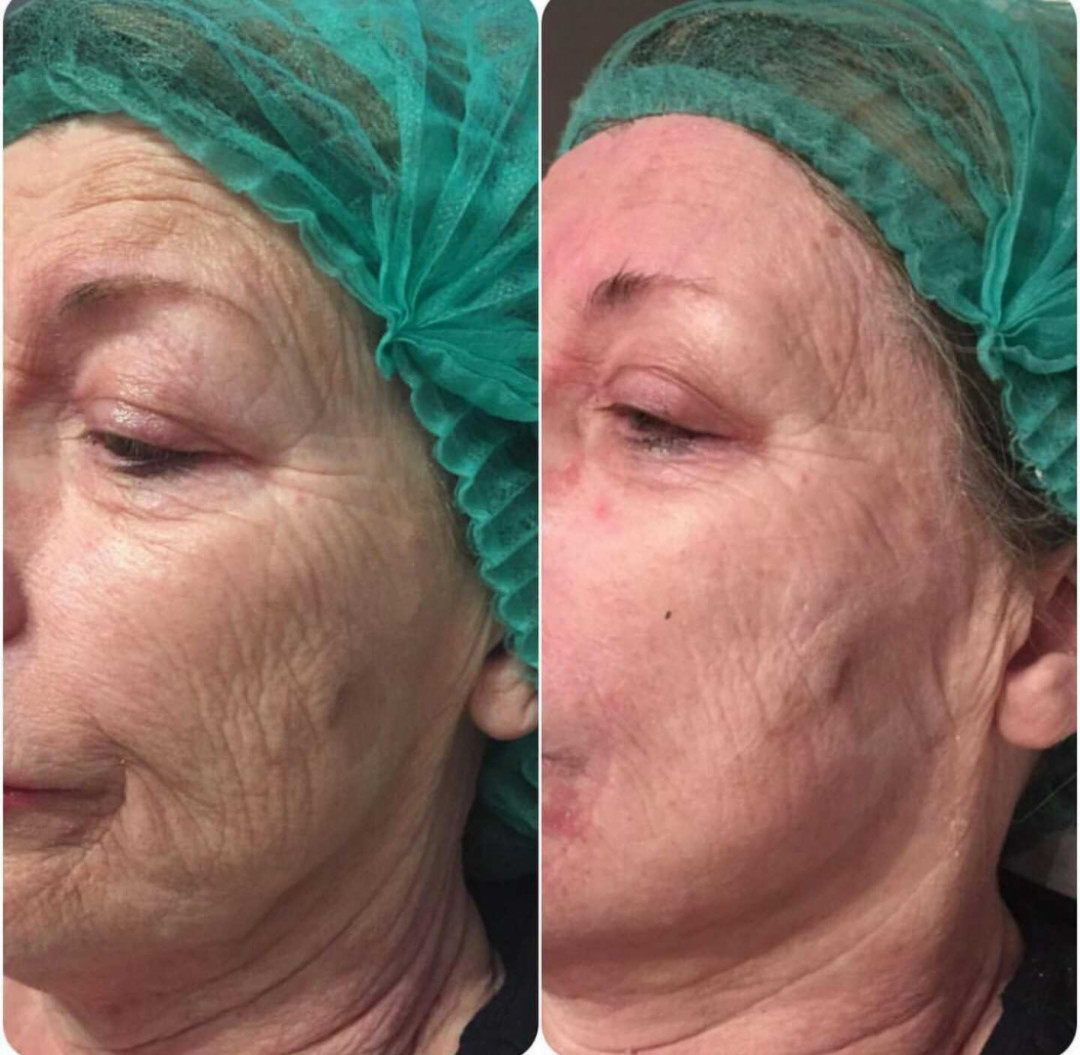 Grossi cosmetic #beograd Tretman lica