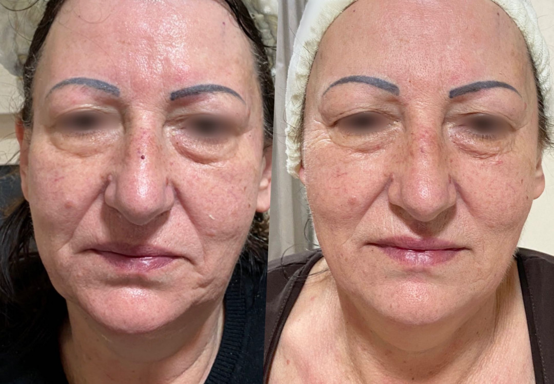 Fam Beauty Box #beograd Tretman lica
