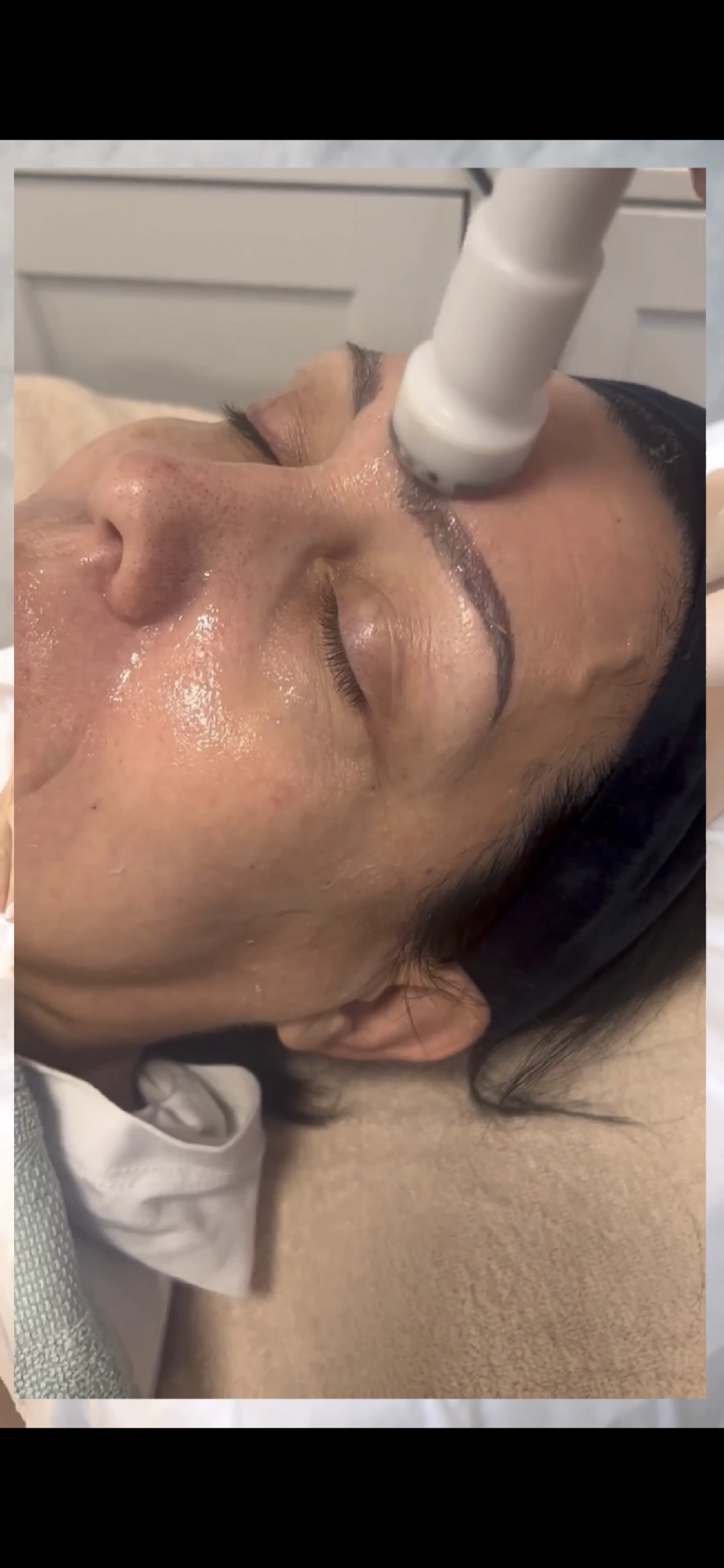 Step up beauty #beograd Tretman lica Mezoporacija lica - anti wrinkles