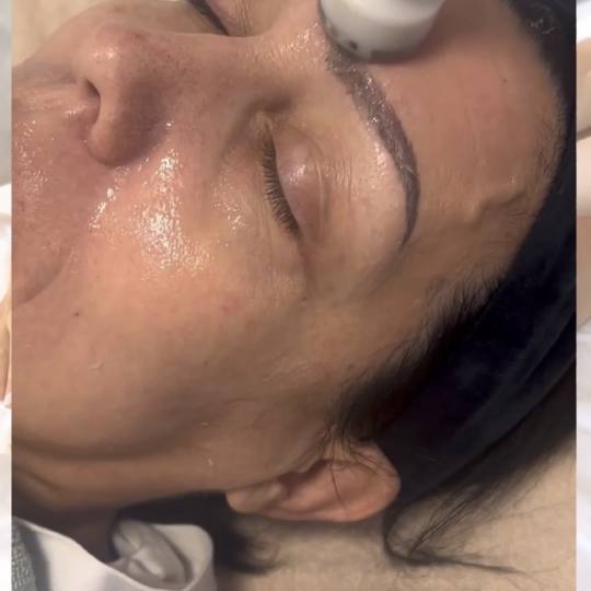 Step up beauty #beograd Tretman lica Mezoporacija lica - anti wrinkles