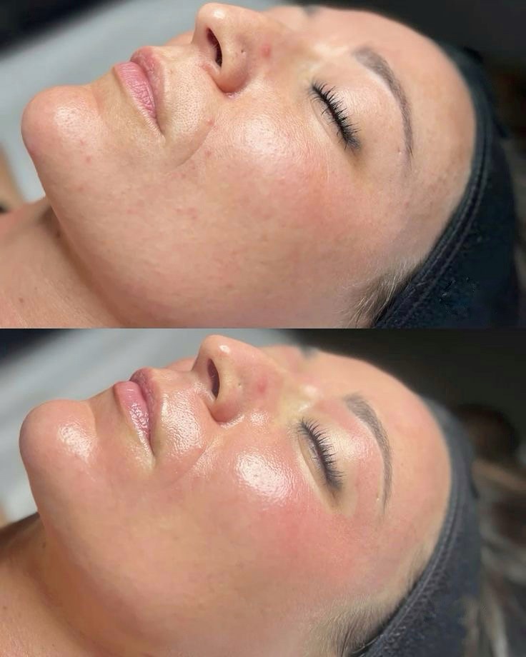Xenija Beauty Room #beograd Tretman lica Dermapen tretman lica