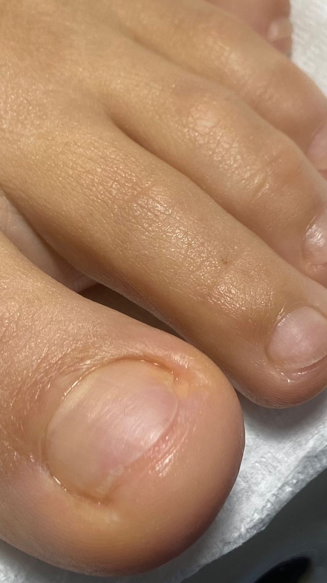 Touch Aesthetic&Medical care #beograd Medicinski pedikir Oniholiza