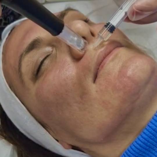 Estetski centar Vlahović #beograd Dermaroler i dermapen Dermapen - ožiljci od akni Crvenilo koje j