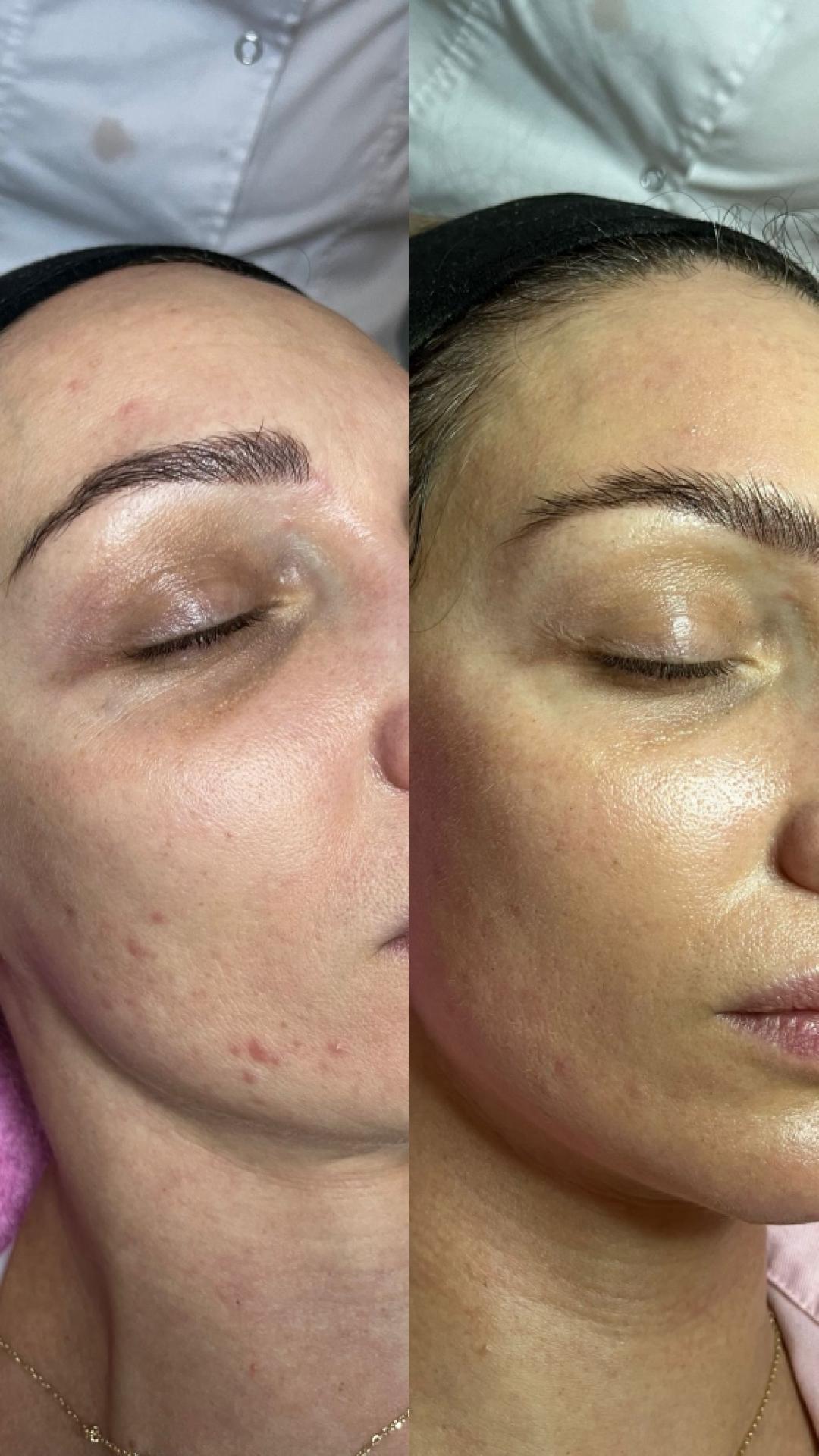 Choco Love #beograd Tretman lica Green peel - Classic