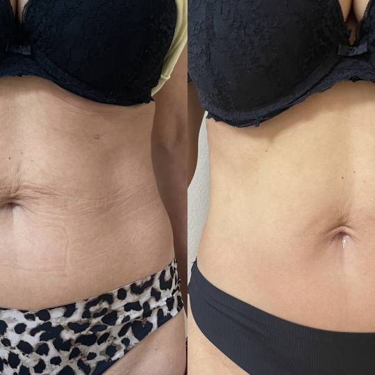 ReNova nutri & beauty #beograd Kavitacija Kavitacija + radiotalasni lifting - po regiji Kavitacija j
