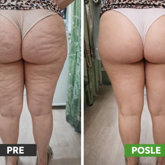 Lady 9 #beograd Anticelulit masaža Maderoterapija - 30 minuta