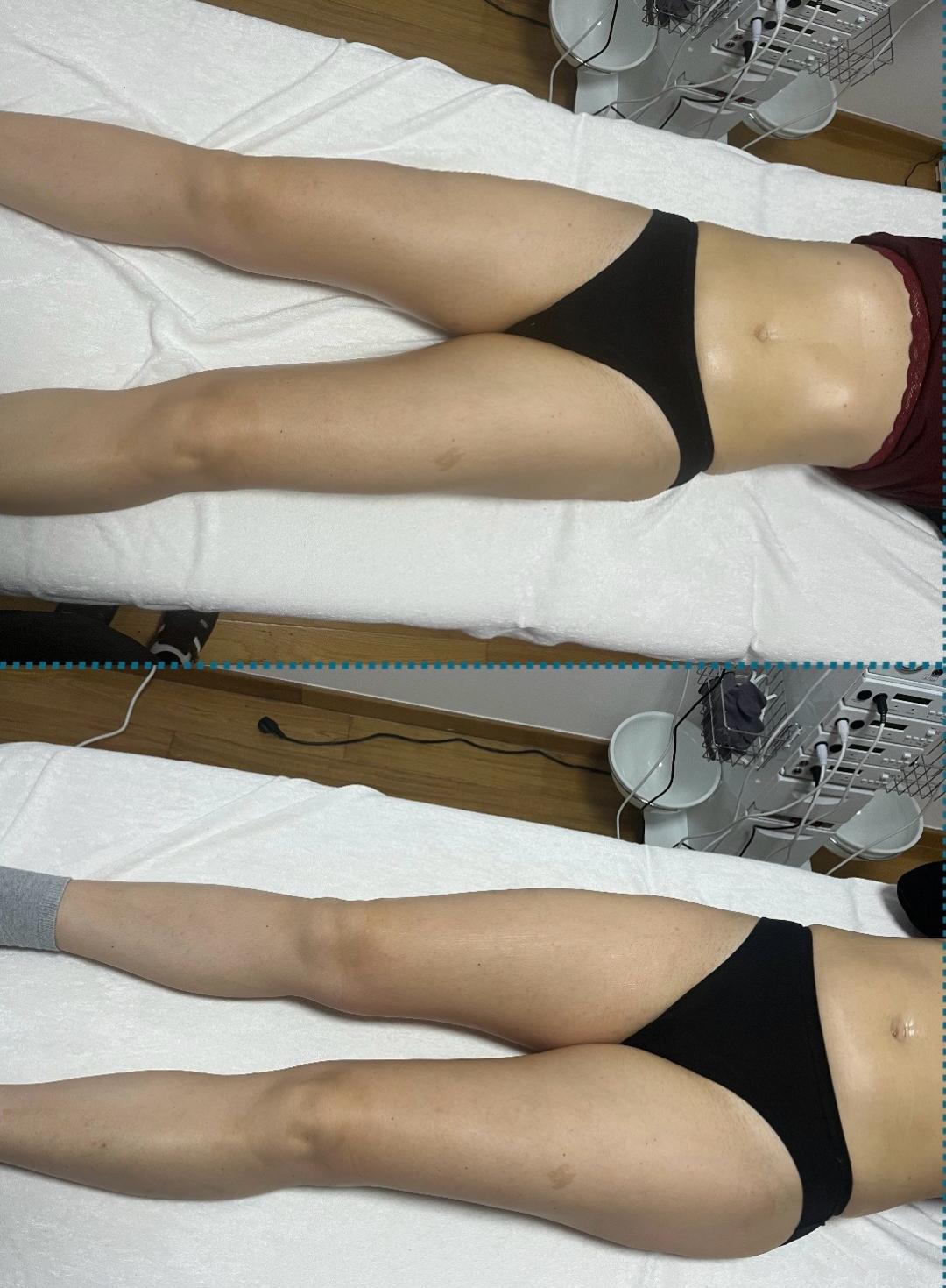 Kavitacija 30min+masaza lipomodelovanje jedne regije - Diamond beauty, Beograd Anticelulit masaža Masaža Anticelulit masaža, Beograd, Zemun Centar