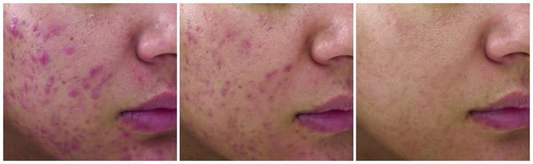 Dubinski tretman lica - komplet - Astradas 2, Beograd Tretman lica Lice Tretman lica, Beograd, Novi Beograd blokovi, Belville, Savski kej