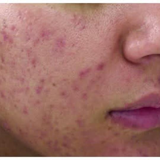 Astradas 2 #beograd Tretman lica Dubinski tretman lica - komplet