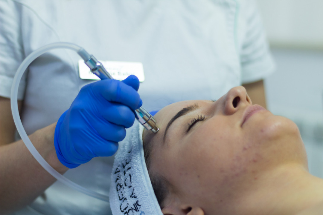 Sonnet beauty concept center #beograd Tretman lica Mikrodermoabrazija