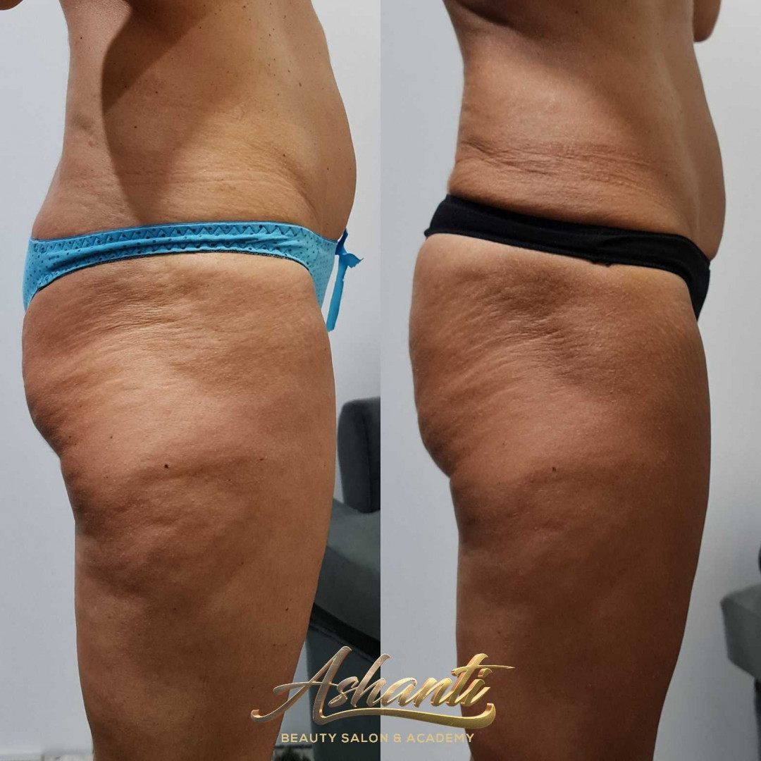 Ashanti Beauty Salon & Academy #beograd Radiotalasni i ultrazvučni tretmani Radiotalasni lifting + vakum sonda - po regiji