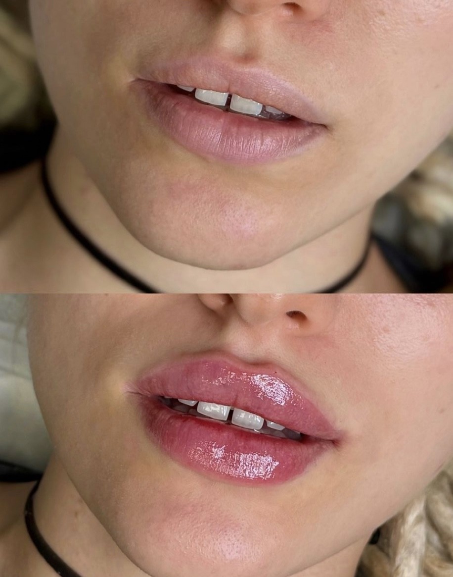 Estetik beauty centar #pancevo Tretman lica Hijaluronski filer iglom-0,5 ml