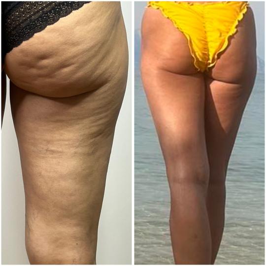 Belle Ana #beograd Tretmani tela Body top tretman 2 regije + anticelulitna masaža