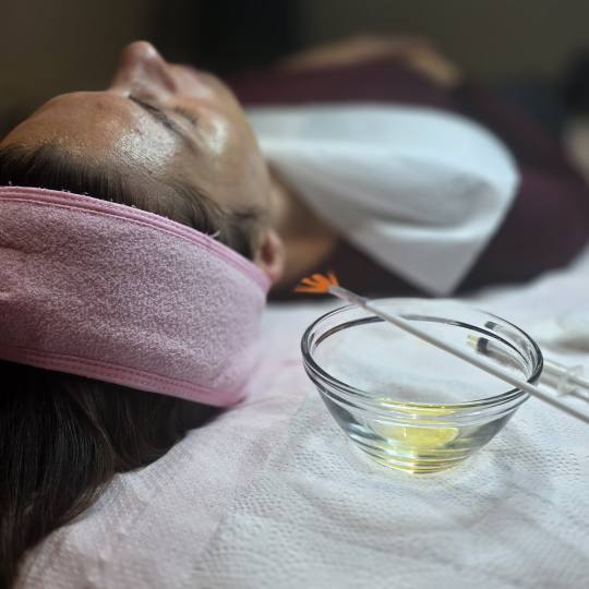 Starmedic #beograd Dermaroler i dermapen Holivudski sjaj - Jessner