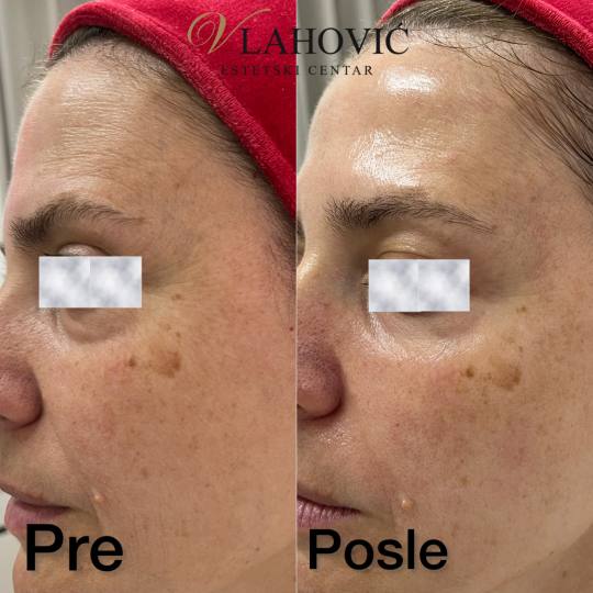 Estetski centar Vlahović #beograd Tretman lica HYDRAFACIAL - regeneracija i rejuvenacija kože Fine