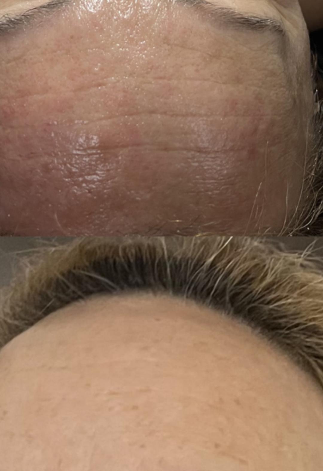 Amelini beauty concept #beograd Dermaroler i dermapen Skinpen-dermapen