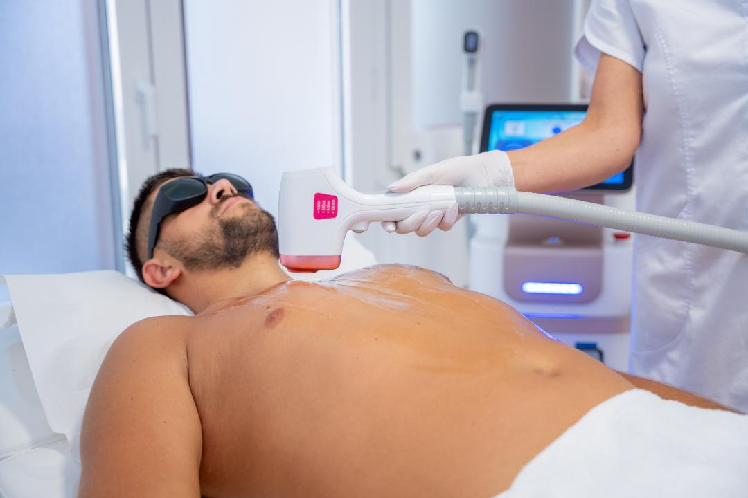 Laserska epilacija grudi - za muškarce - Monika Barta Cosmetics - Subotica, Subotica Laserska epilacija Depilacija Laserska epilacija, Subotica, Centar