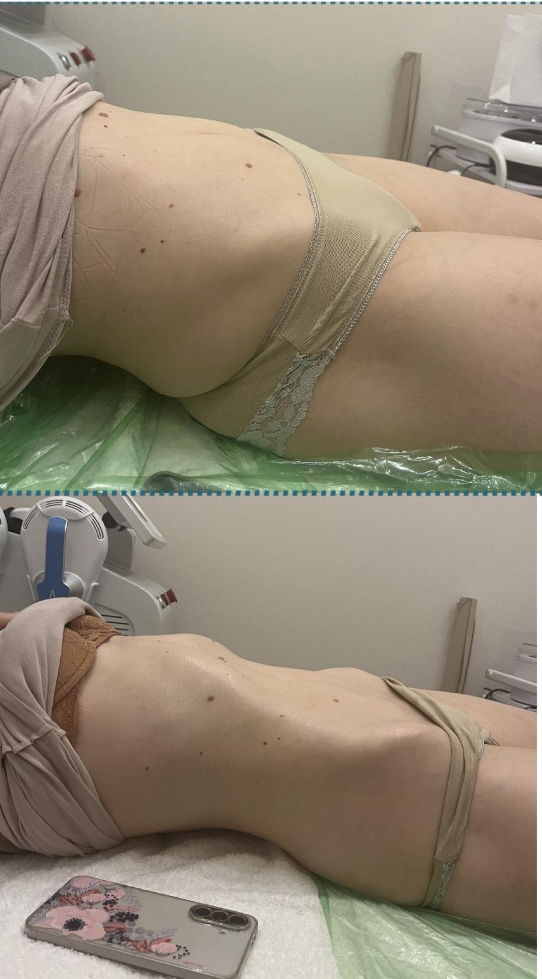 Vacum 65 body + limfna drenaža - Diamond beauty, Beograd Anticelulit masaža Masaža Anticelulit masaža, Beograd, Zemun Centar