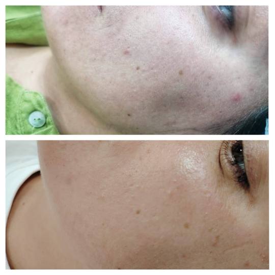 MediBella Aesthetic Dedinje #beograd Tretman lica Skin glow tretman - dermapen 4 + PRX + LED lampa +