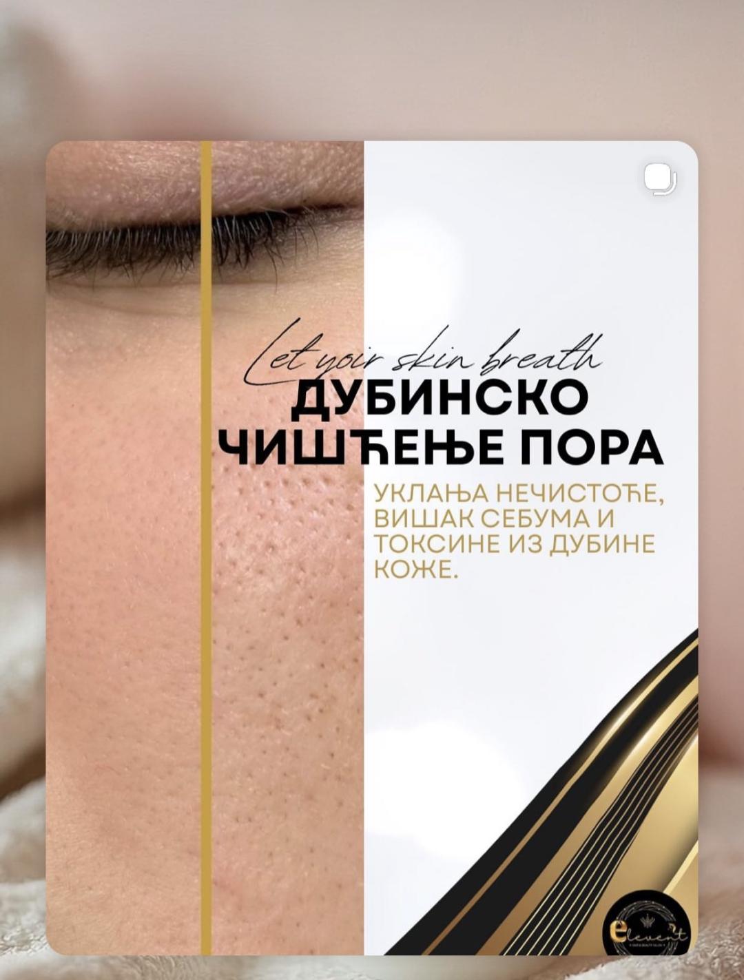 Elevent #beograd Radiotalasni i ultrazvučni tretmani Raditalasni lifting - lice