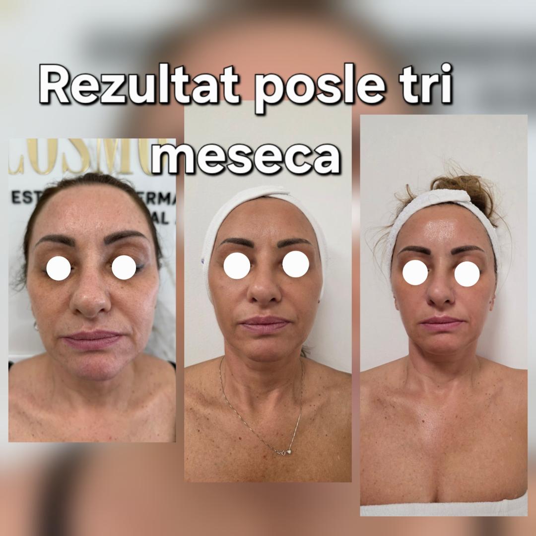 Beauty Vreme za mene #novisad Tretman lica AKCIJA 9D HIFU LICA +HIGIJENSKI TRETMAN+OXYGEN TRETMAN