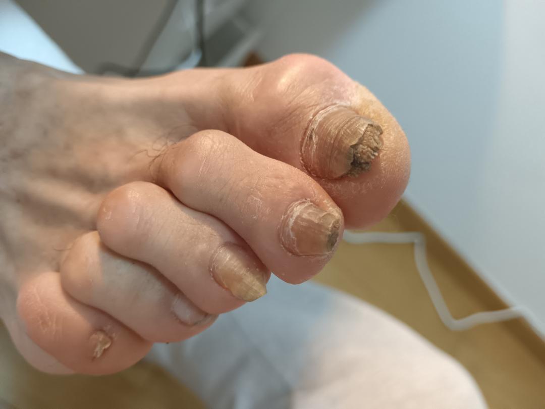 Moja Slavica #beograd Medicinski pedikir Medicinski pedikir