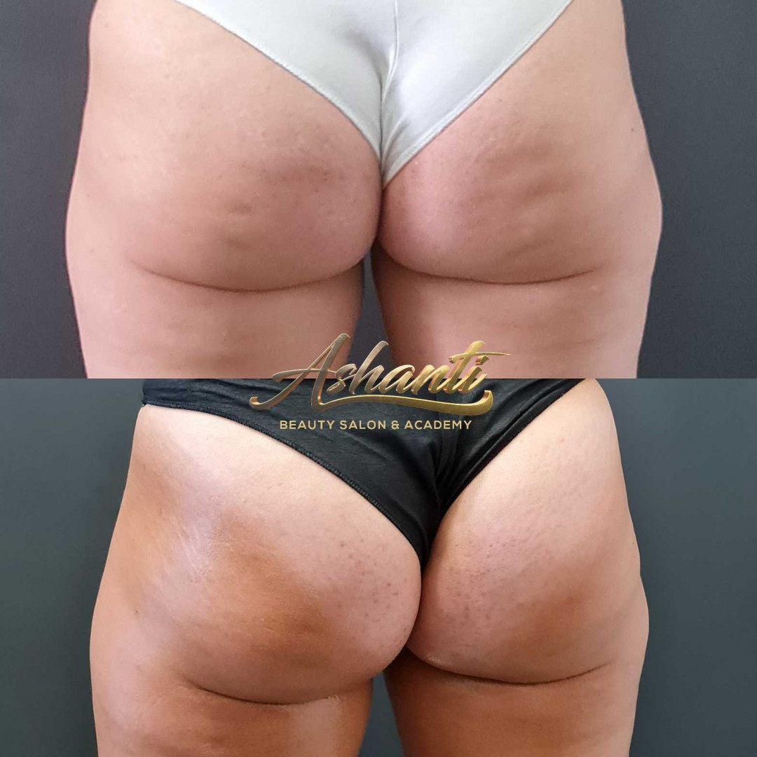 Ashanti Beauty Salon & Academy #beograd Masaža za mršavljenje Dermapen - regija lica