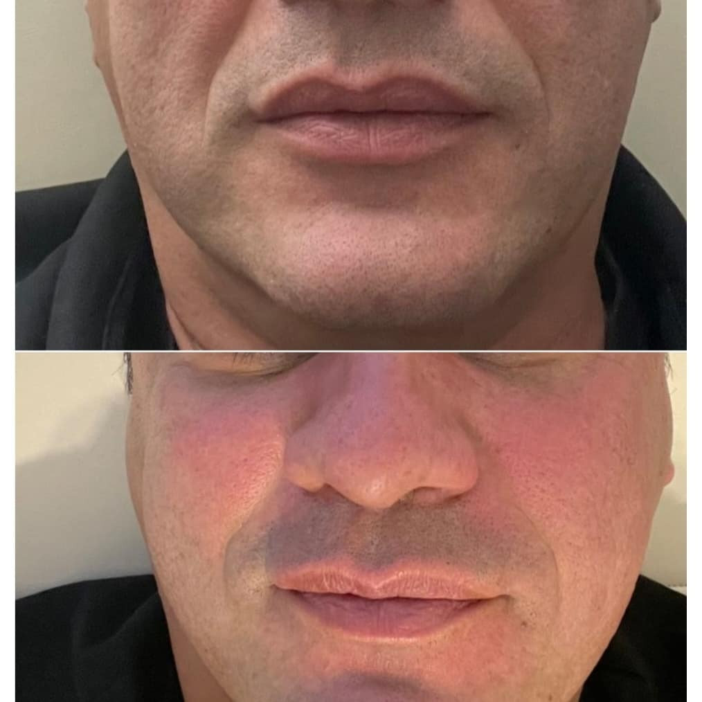 Lipolaser Centar - Matrix021 #novisad Tretman lica