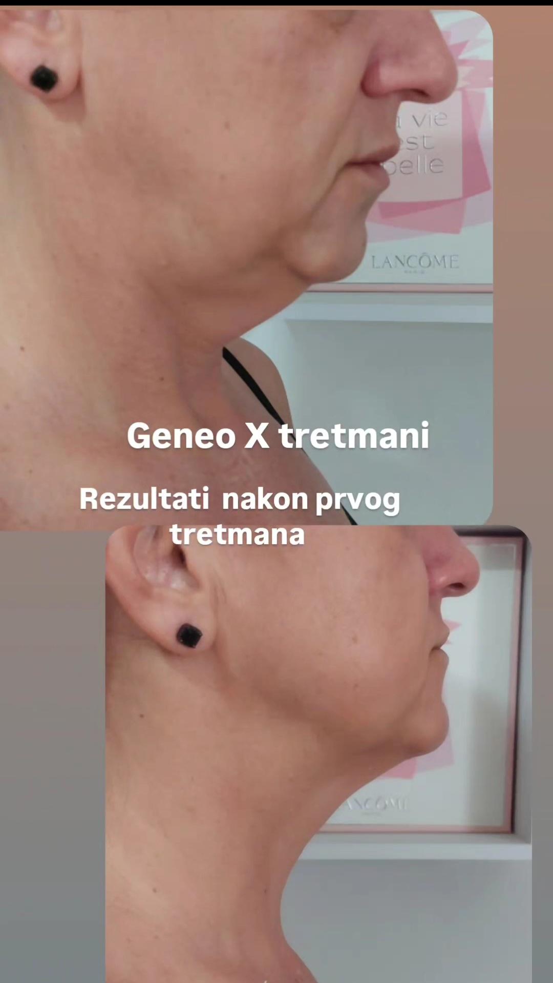 Geneo X lux Premium nehirurški lfting paket 3 tret. - Anita M, Novi Sad Tretman lica Lice Tretman lica, Novi Sad, Sajmište, Detelinara, Banatić