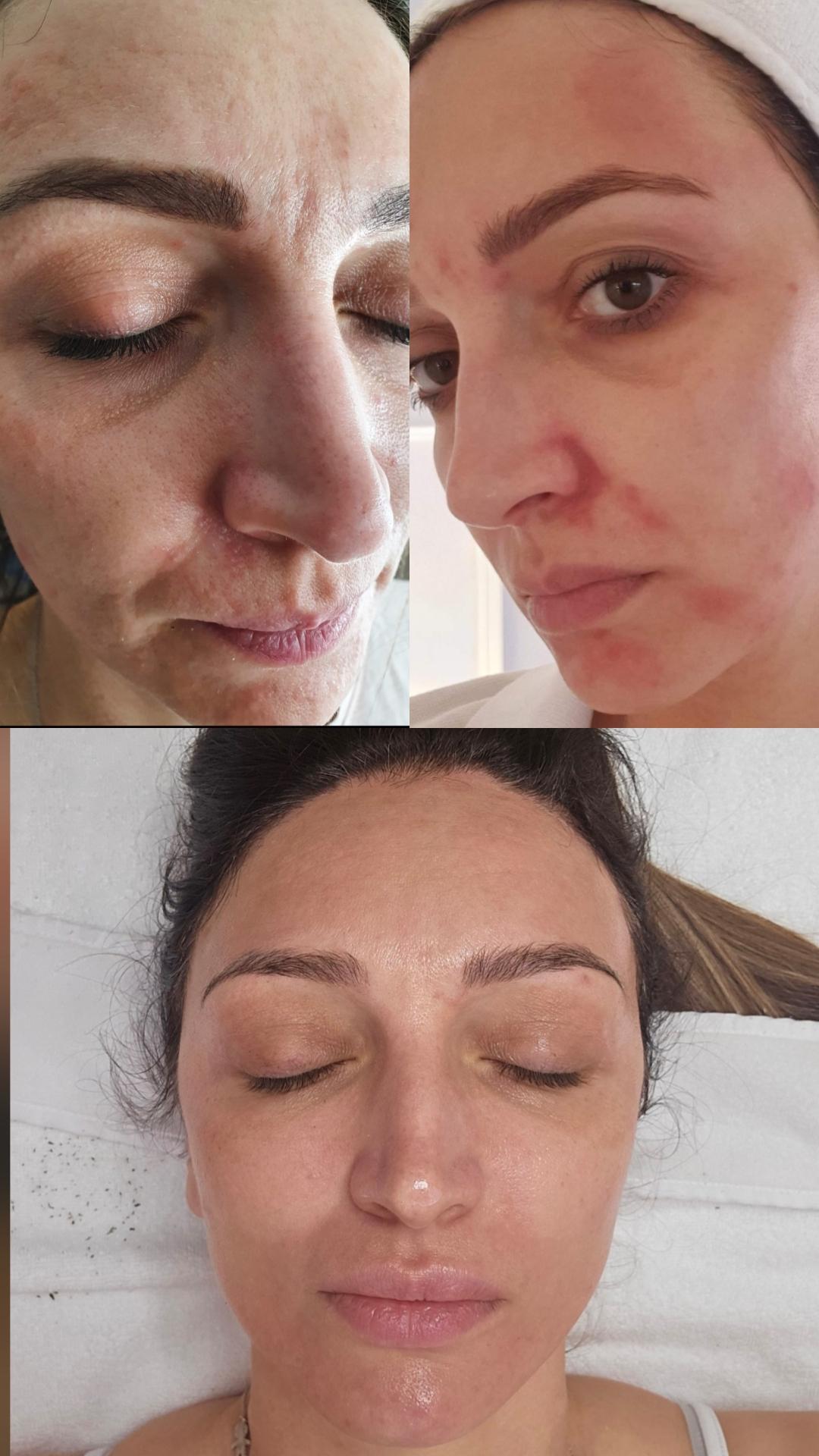 Choco Love #beograd Tretman lica Green peel - Energy