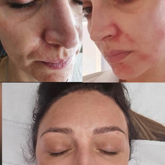 Choco Love #beograd Tretman lica Green peel - Energy GREEN PEEL® Energy: Idealno za kožu sa flekam