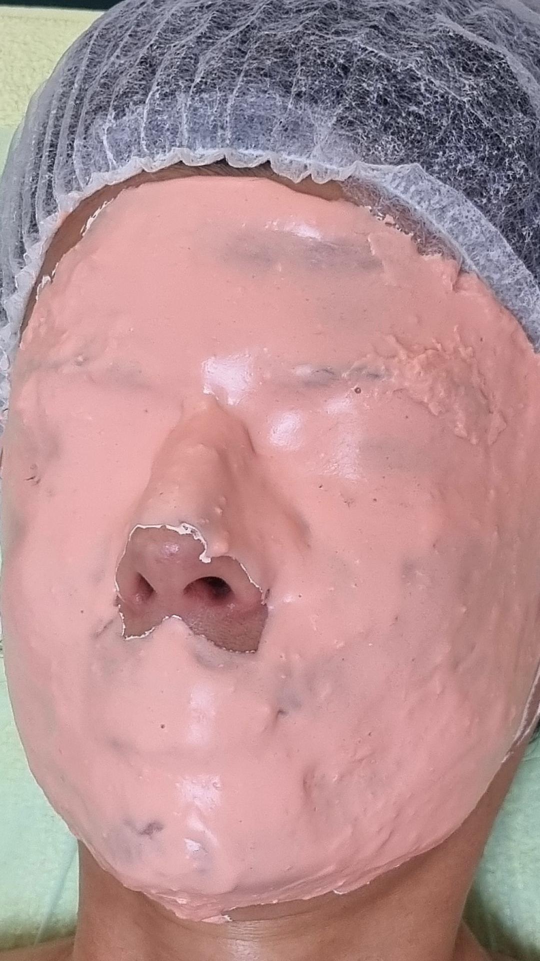 Skin boosters tretman lica - Emilly, Beograd Tretman lica Lice Tretman lica, Beograd, Dušanovac, Šumice