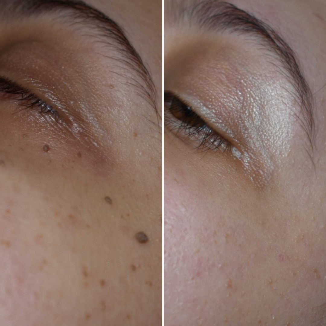 Beauty fit #beograd Tretmani tela Uklanjanje bradavica